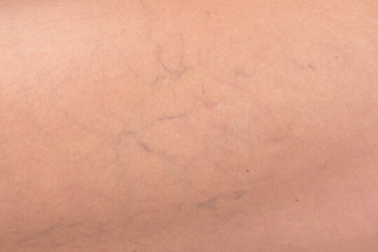 Macro photo showing varicose veins and capillaries on a woman’s skin. Close-up detail of vascular issues for dermatology, medicine, and aging body care concepts.