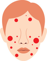 Medical Illustration of Human Face with Severe Acne, Red Spots, and Skin Rash Symptoms for Dermatology and Healthcare Education