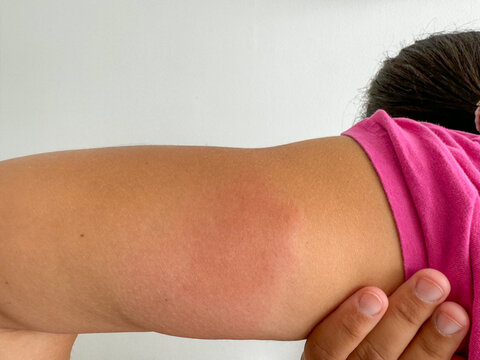 Severe allergic reaction to wasp sting on arm, close up of swollen red skin, insect bite inflammation