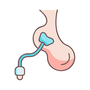 Illustration of hydrocele condition with catheter in cartoon style