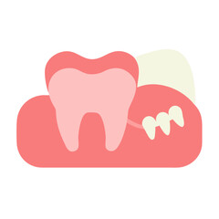 Impacted wisdom tooth anatomical illustration against a black background