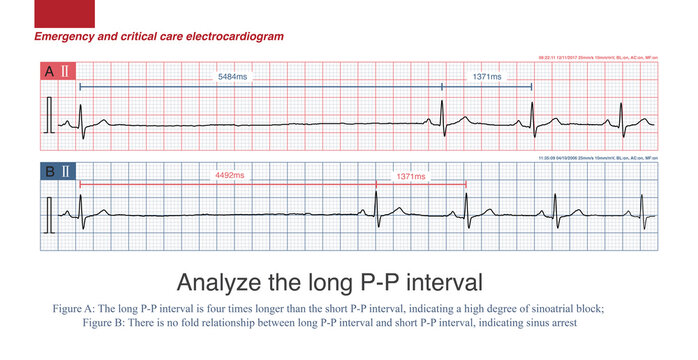 Under normal circumstances, the anterior branch of the U wave of the electrocardiogram forms quickly, while the posterior branch forms slowly, so the shape of the U wave is asymmetric.
