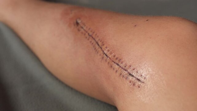 Healing surgical wound covered with medical stitches and bandage on a human leg
