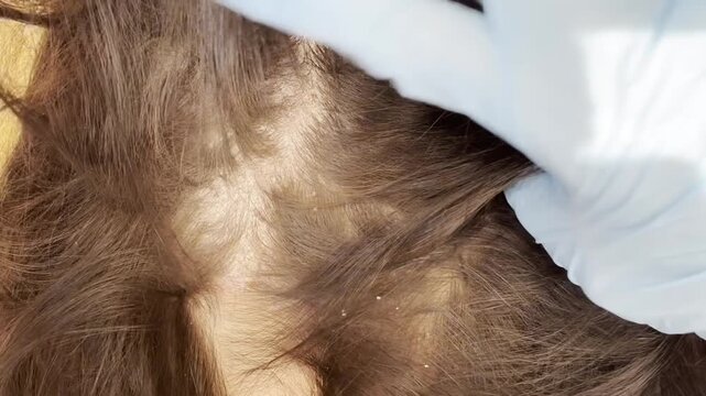 Dermatologist examining scalp of brunette woman with psoriasis, wounds, white plaques and peeling. Diagnosis of autoimmune skin disease and treatment concept
