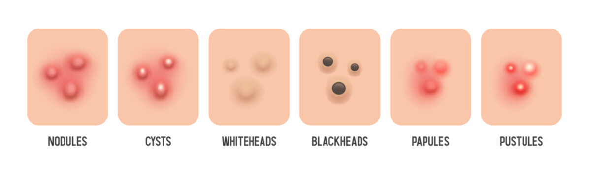 Acne. Types of acne. Papules, pustules, cysts, blackheads, etc. Vector illustration