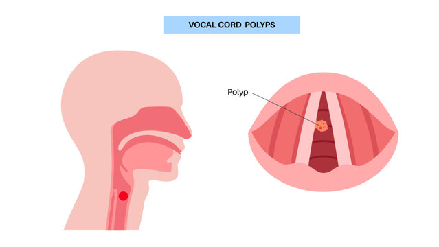 Vocal cord polyps