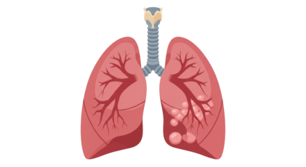 Human Lungs with Disease and Tumors Illustration illustration featuring science, diagram, tumor, malignant, ill,