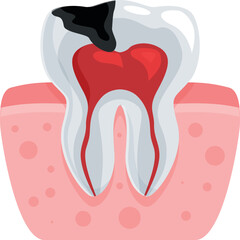 Cross section of a decaying tooth with inflamed pulp and gum inflammation, illustrating dental issues