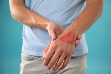 Man with burned hand on light blue background, closeup