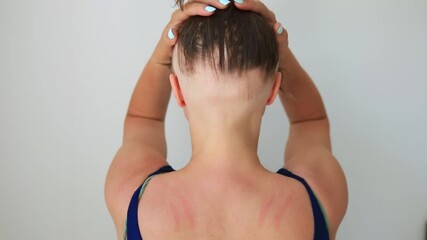 a woman showing of experiencing hair loss due to alopecia, an autoimmune condition exacerbated by COVID 19. She reveals her bald head, the importance of self acceptance