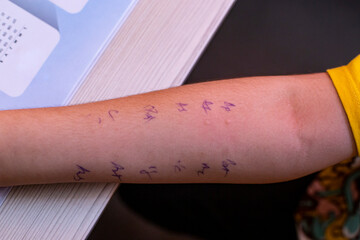 Skin Prick Allergy Test on a little child's arm,  positive results closeup