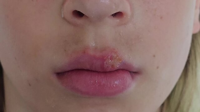 Herpesvirus infections in children. Herpes in a child is essentially a chronic recurrent infection caused by virions of the herpes simplex virus
