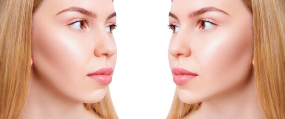 Woman before and after cheekbones shape correction.