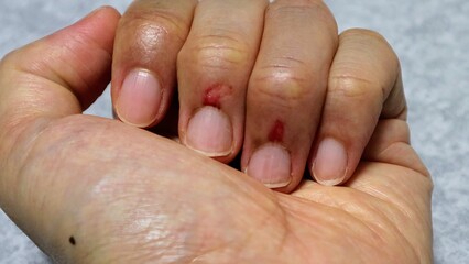 ささくれした指のクローズアップ