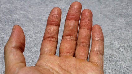 カサカサの手のクローズアップ