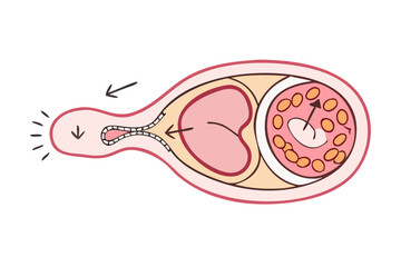 Illustration of sperm entering the fallopian tube to fertilize egg