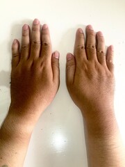 Human hands showing tan lines on wrists caused by sun exposure