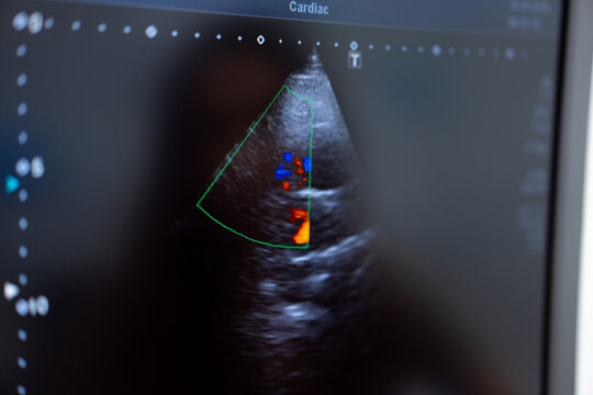 Heart activity via cardiac ultrasound. Detailed cardiac ultrasound displaying heart activity with colorful flow patterns and structural outlines of the heart.