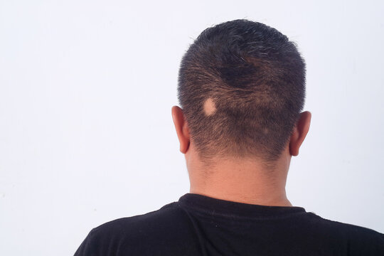 Back view of a man with alopecia areata on the scalp, showing a bald patch on the head. Hair loss problem, dermatology, and healthcare concept.