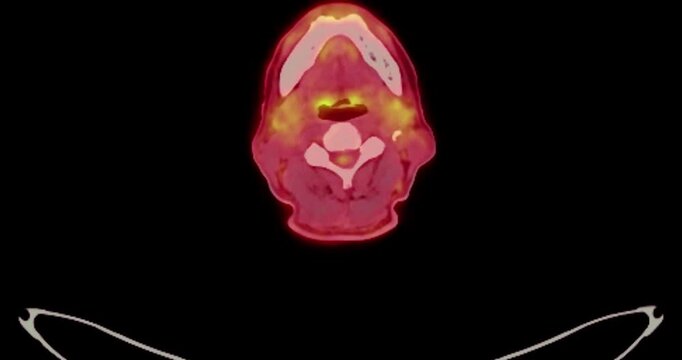 PET scan footage of the Whole Body scan highlighting areas of metabolic activity, essential for diagnosing conditions like Alzheimer's, tumors, and epilepsy.