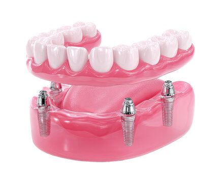Dental implant-supported denture.  Pink denture with teeth and metal implant posts.  3D render of dental prosthesis