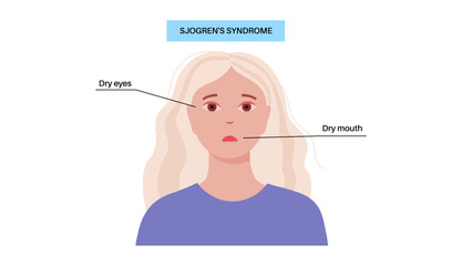 Fototapeta premium Sjogrens syndrome disease