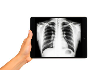 Hand holding tablet displaying chest x ray isolated on transparent background