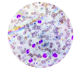 Photomicrograph of hematological slide showing RBC, WBC (Neutrophils and Eosinophil) and platelet. Normal hemogram. CBC