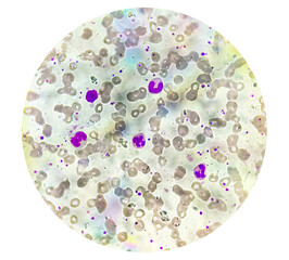 Photomicrograph of hematological slide showing RBC, WBC (Neutrophils and Eosinophil) and platelet. Normal hemogram. CBC