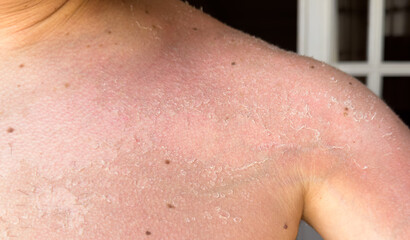 Naklejka premium Sunburn, peeling skin, burns, skin problem, vertigo, health, summer and sun. High quality