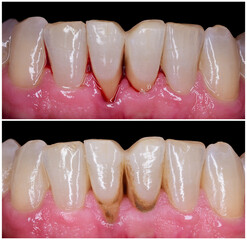 teeth tartar and calculus cleaning