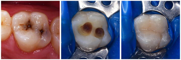 tooth felling before and after picture