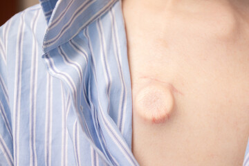 Closeup of medical chemotherapy port implanted under the skin on patient&rsquo;s chest, concept of oncology treatment, intravenous access device and cancer care.