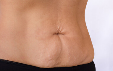 Cropped female body with lower belly pooch and visible stretch marks