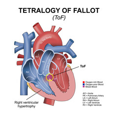 Tetralogy of Fallot (ToF) Heart Flashcard