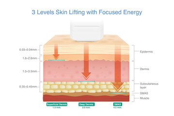 Medical device shoot heat energy to the skin layer at three different depths. Facial Skin lifting treatments with stimulating collagen and Elastin in the skin with Ultherapy and Radio Frequency Device