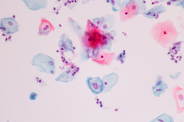 Abnormal human squamous epithelial cells view in microscopy.HPV criteria for pap smear slide cytology and pathology.Koilocyte cells on white background.Woman cervical cancer cell medical concept.