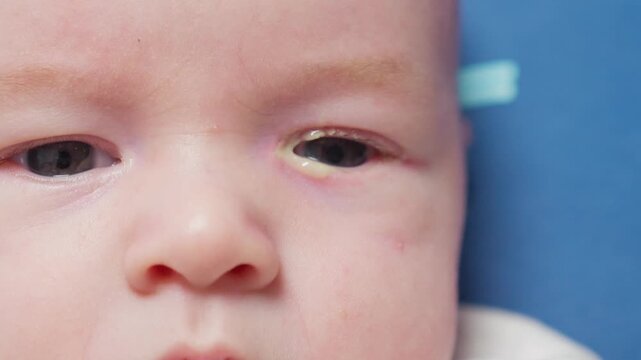 Baby eyes with eye mucus in selective focus. Disease tear ducts tons of newborns close up. Nasolacrimal duct obstruction in baby it is a blockage of the lacrimal drainage system. 