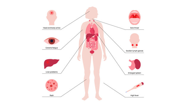 Mononucleosis symptoms poster
