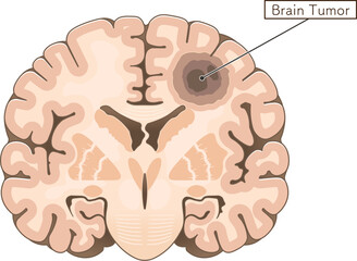 前頭断面_脳腫瘍のイラスト Brain tumor illustration