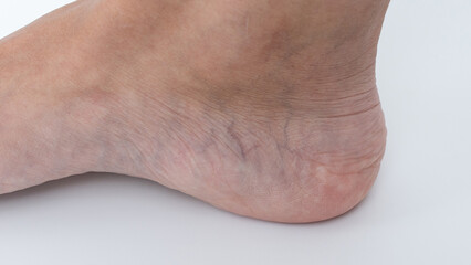 Fototapeta premium Varicose veins visible on a woman's leg, showcasing skin texture and condition, emphasizing health concerns and aesthetic issues related to circulation