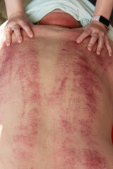 A close-up of a person's back after a traditional therapy session. Red marks and bruises are visible on the skin. The therapist's hands are visible at the top, applying pressure.