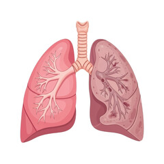 Anatomical Illustration of Healthy and Diseased Lungs