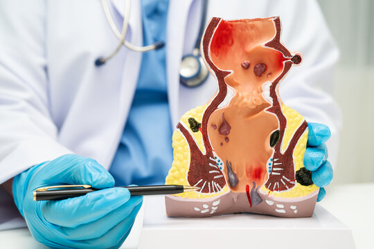 Asian doctor with rectum and hemorrhoid human anatomy model at hospital, inflamed vascular structure.