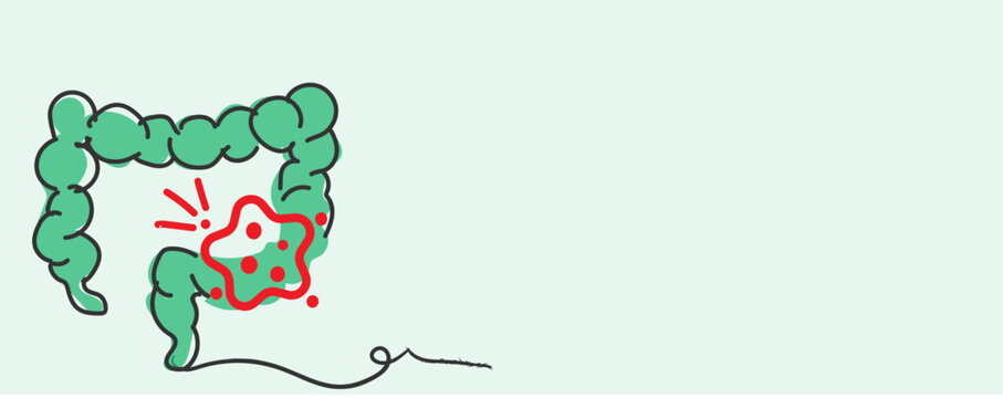 Early Detection of Colorectal Cancer Screening and Prevention Strategies