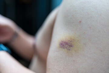Fototapeta premium Close up of a bruise in the arm of man