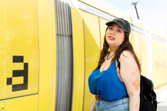Young woman with vitiligo waiting for public transport