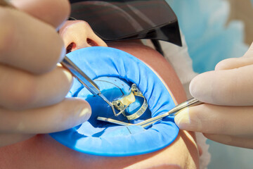 Patient getting dental treatment at dentist office with dental rubber dam protection