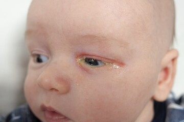 Baby eyes with eye mucus in selective focus. Disease tear ducts tons of newborns close up. Nasolacrimal duct obstruction in baby it is a blockage of the lacrimal drainage system. 