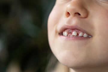 A child with missing teeth smiles in close-up. Loss of baby teeth. Caring for children's teeth